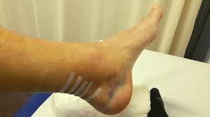 Achilles Heel Surgery