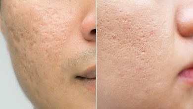 Acne Scars: Causes, Treatments, and Tips
