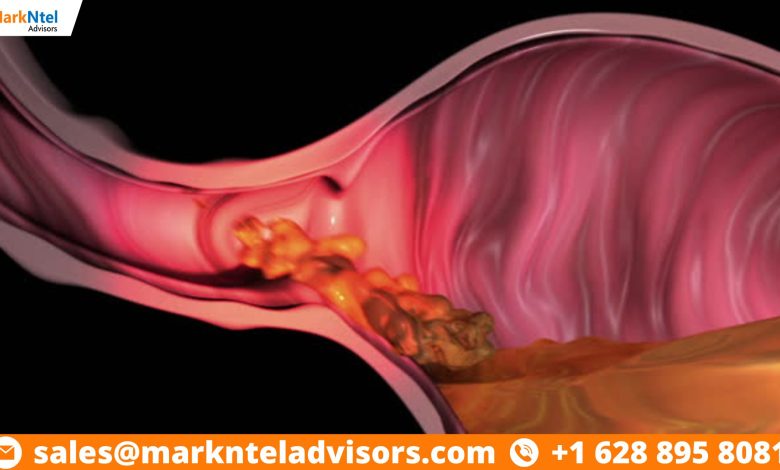 Gastroesophageal Reflux Disease Device Market