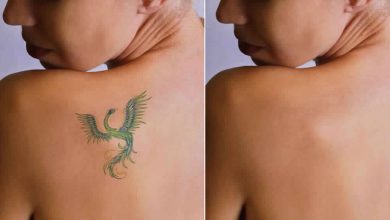 Laser Tattoo Removal