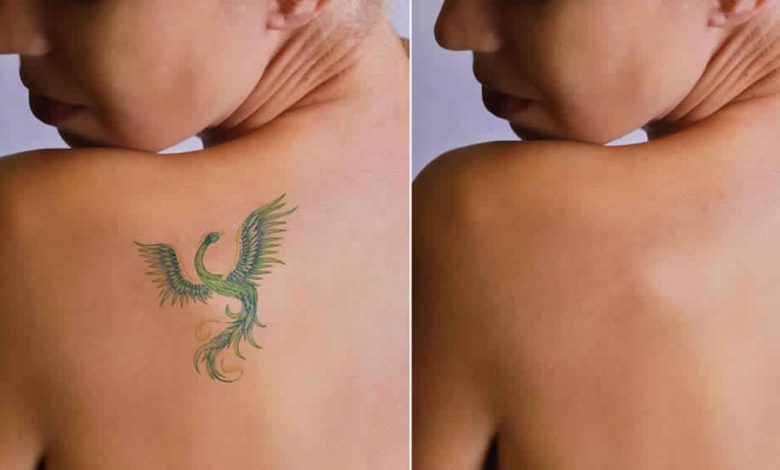 Laser Tattoo Removal