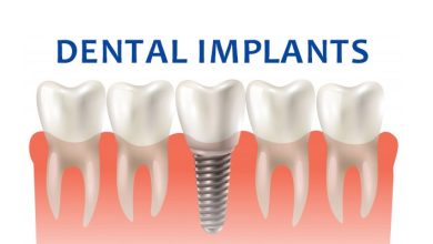 Best Dental Implants in Houston: Restoring Your Smile