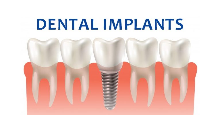 Best Dental Implants in Houston: Restoring Your Smile