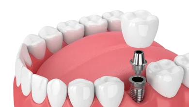 Dental implants Oakville