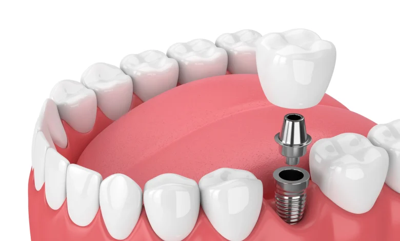 Dental implants Oakville