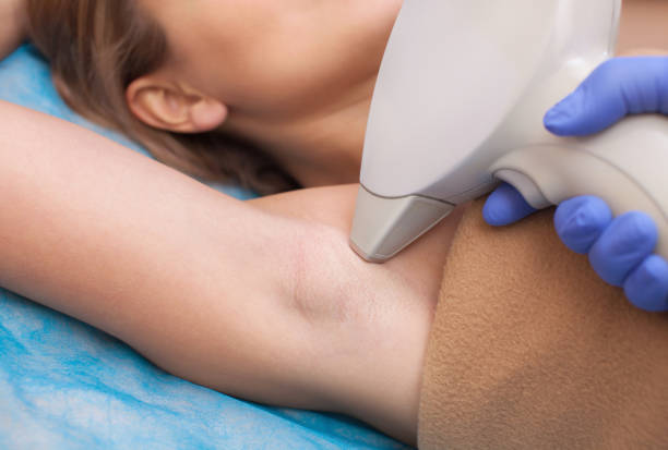 laser hair removal Toronto