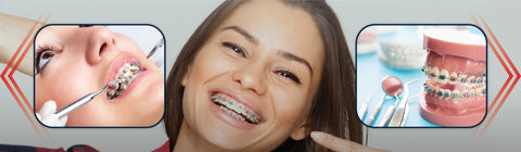 how put on braces orthodontic tools