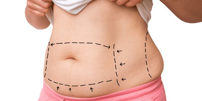 tummy tuck surgery