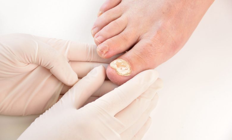 Home Remedies for Ingrown Toenails in Singapore